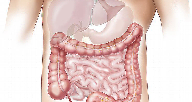 ULCERATIVE COLITIS – WHAT IS IT?