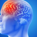 Migraine Plus Hormonal Imbalances